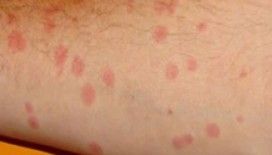 Rüyada benek görmek ne demek ?