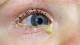  Rüyada çapak görmek ne demek ?