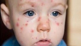  Rüyada çiçek hastalığı görmek ne demek ? 