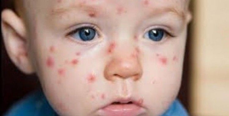  Rüyada çiçek hastalığı görmek ne demek ? 