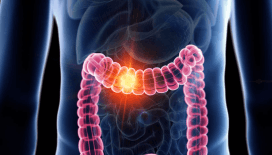 Kolon kanserinde umut verici klinik deney: Ölüm riski ciddi oranda azalıyor