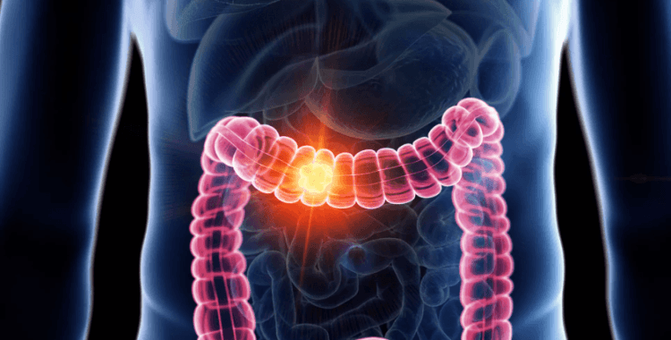 Kolon kanserinde umut verici klinik deney: Ölüm riski ciddi oranda azalıyor